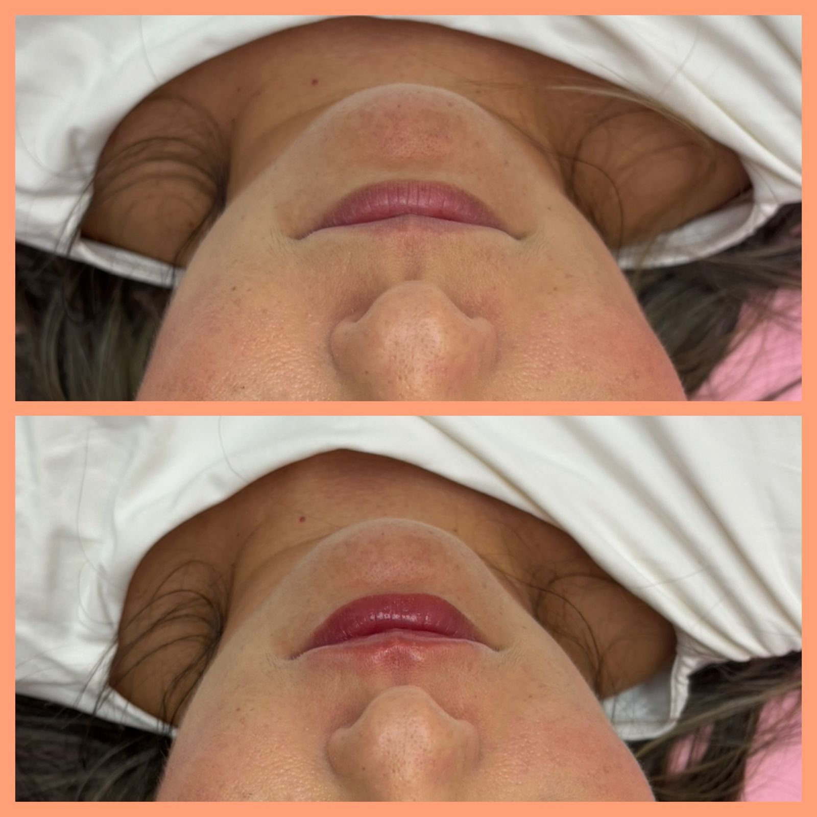 Antes y Despues Labios