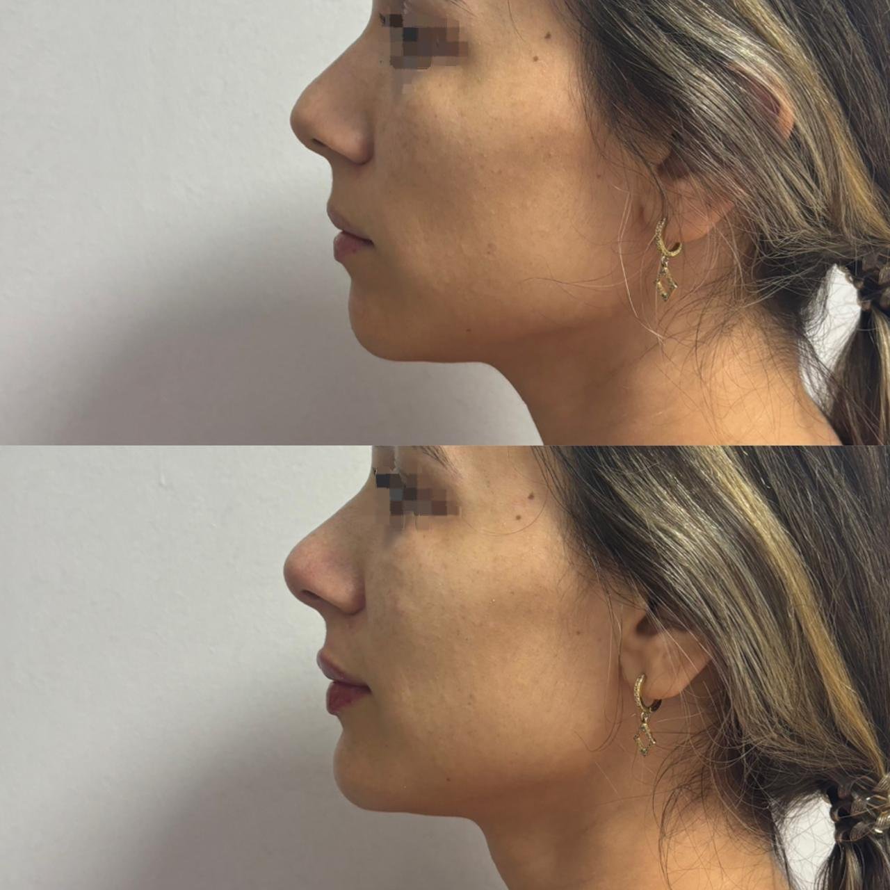 Armonización Facial